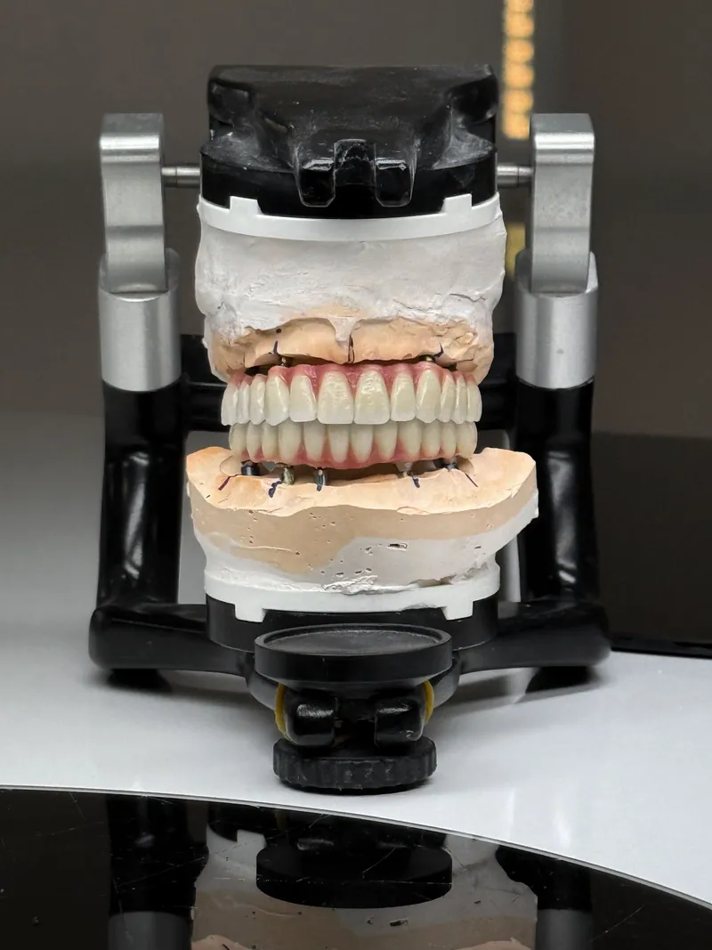 Dental models mounted on an articulator