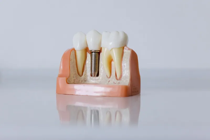 Cutaway dental model showing an implant crown between two natural teeth