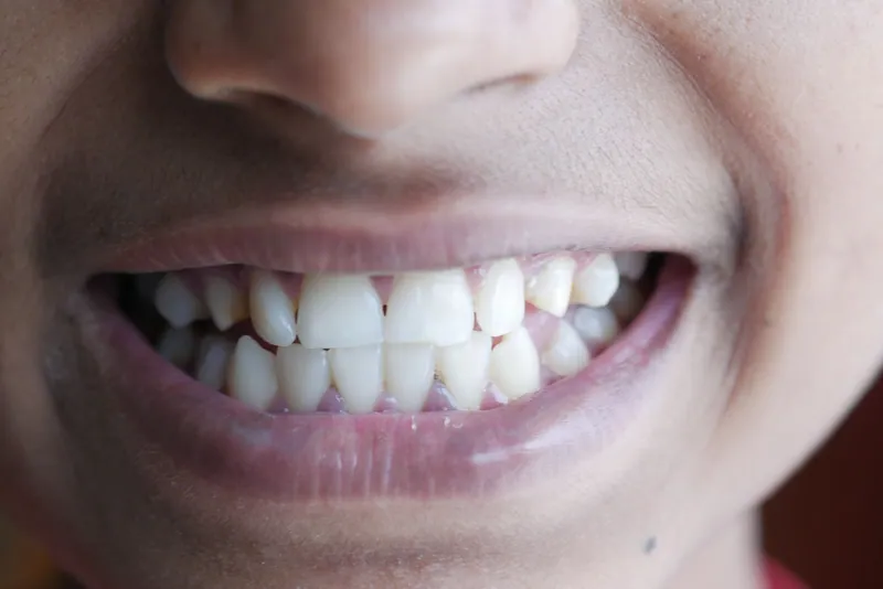 Close-up of a natural smile showing the upper front teeth